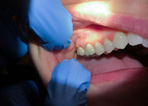 Best Urgent Care for Lost Fillings or Crowns in Takoma Park, MD